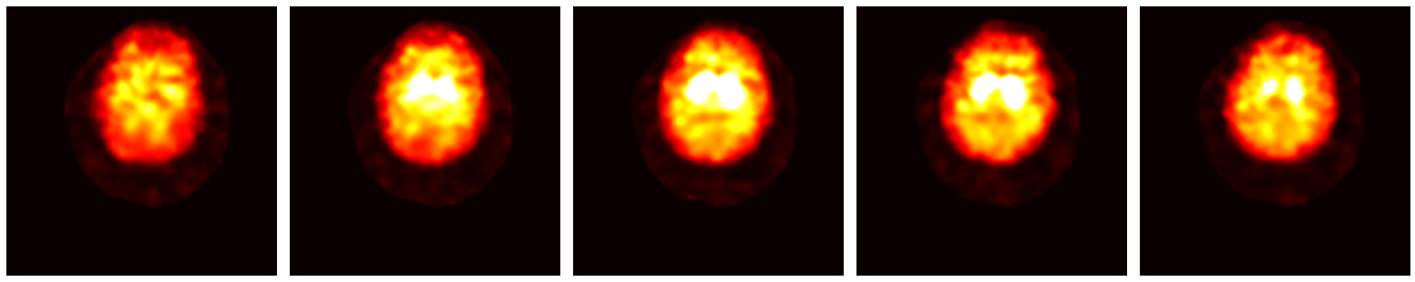 Several axial slices through an example DaT scan, displayed with a hot colormap